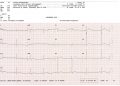 12-lead electrocardiogram (ECG) printout
